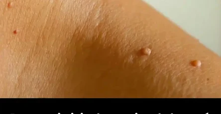 Pourquoi ai je des grains de beaute couleur chair sur le cou ou sous les aisselles et comment men debarrasser des experts vous expliquent.jpg