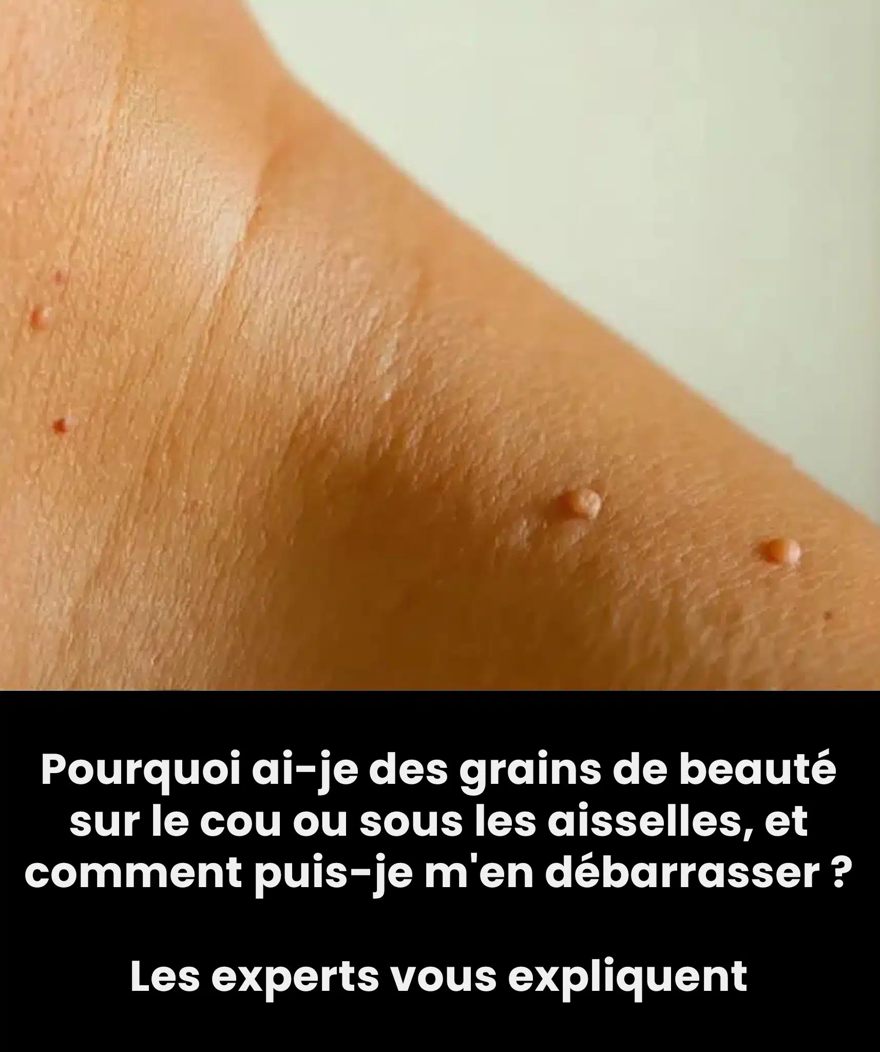 Pourquoi ai je des grains de beaute couleur chair sur le cou ou sous les aisselles et comment men debarrasser des experts vous expliquent.jpg
