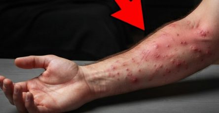 Arm with red marks
