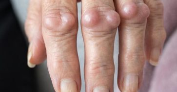 Elderly hand with arthritic nodules 202608031447