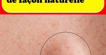 Lipome